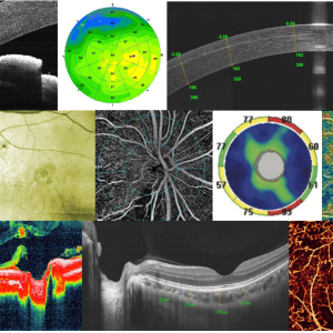 OCT Tomografía Ocular
