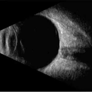Ultrasonido Ocular