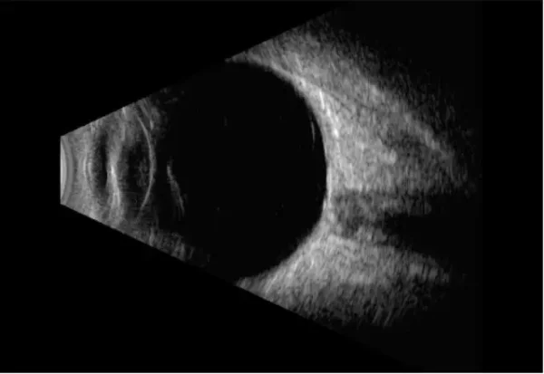 Ultrasonido Ocular